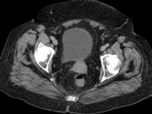 Computed tomography image showing increased densification of the right side of the Perirectal fat.