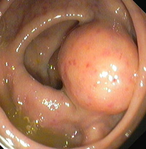 Colonoscopic findings showing subepithelial lesion with normal overlying mucosa.