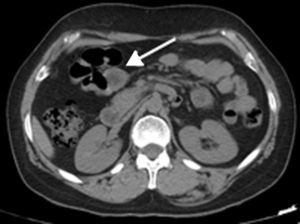 Computed tomography scan showed a well-defined homogeneously enhancing subepithelial mass in the wall of the ascending colon (arrow).