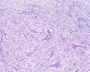 Histological examination revealed spindle cells arranged in bundles, with dense distribution of nucleus forming palisades in dense fibrillar stroma (hematoxylin & eosin, 40×).