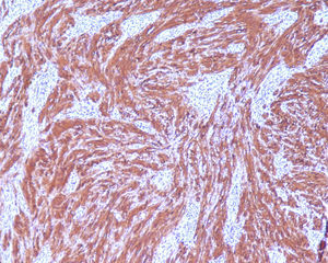 Immunohistochemistry staining shows a diffuse cytoplasmic immunoreactivity for S-100 protein (100×).