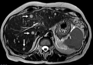 Abdominal MRI, T2-weighted image, axial plane. Several hyperintense lesions affecting both hepatic lobes representing multifocal epithelioid hemangioendothelioma.