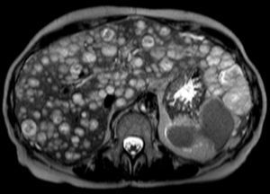 Abdominal MRI, T2-weighted image, axial plane, 4-weeks after initial MRI. Progression of the disease with uncountable multifocal epithelioid hemangioendothelioma lesions.