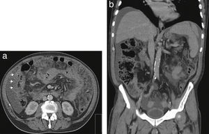 Abdominal computed tomography showing parietal thickening of colonic flexure. (A) Axial view. (B) Coronal view.