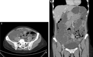 CT enterography: Mesenteric hypervascular lesion in the mid ileum (axial and coronal views).