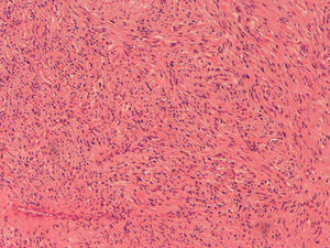 Haphazardly oriented small fascicles and turbinate spindle-cell without pleomorphism or mitotic activity (HE, 200×).