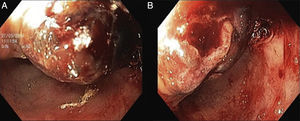 Endoscopy of the upper gastrointestinal tract showing a dark reddish polypoid lesion with 30mm of maximum diameter that occluded half of the lumen of the duodenum.