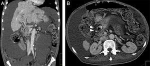Abdominal computed tomography, coronal view, showing multiple liver masses located in the left hepatic lobe with 19.9cm of maximum extension (Fig. 3A). The local invasion of the first part of the duodenum by the HCC is point out with an arrow in Fig. 3B (axial view).