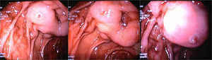 Duodenal varix with a fibrin plug at the second portion of duodenum.