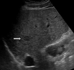 Small hypoechoic nodule in a cirrhotic liver corresponding to an HCC (arrow).