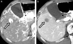 HCC during dynamic CT (arrow): arterial phase (a) and portal phase (b).
