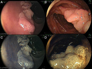 The mucosal surface was carefully analyzed using high resolution white light endoscopy (A) and standard or virtual chromoendoscopy methods (B). Chromoendoscopy may be useful for determining the borders and extend of the lesion (B).