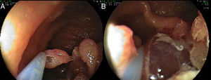 Large sessile polyps (>10mm) were removed using the piecemeal technique (A and B).
