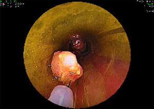 When performing piece meal mucosectomy all pieces of the resected lesion were removed through the overtube.