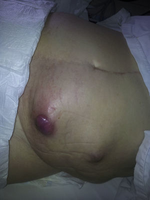 The abdominal examination revealed a distended and asymmetric abdomen with multiple visible and palpable masses, one of them in the left lower quadrant covered with purple skin.