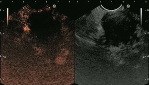 Screen capture of video sequence of contrast-enhanced harmonic endoscopic ultrasonography (left panel). The video sequence also included a B-mode standard EUS image of the lesion of interest (right panel). This lesion has a hypo-enhancement pattern suggestive of pancreatic adenocarcinoma (this was confirmed by EUS-FNA).