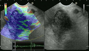 Screen capture of video sequence of endoscopic ultrasound elastography (left panel). The video sequence also included a B-mode standard EUS image of the lesion of interest (right panel). This lesion has a heterogeneous blue-predominant pattern suggestive of pancreatic adenocarcinoma (this was confirmed by EUS-FNA).