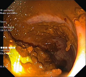 Endoscopic view of the microenema device in the rectum.