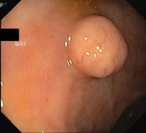 Submucosal tumor in the middle rectum.
