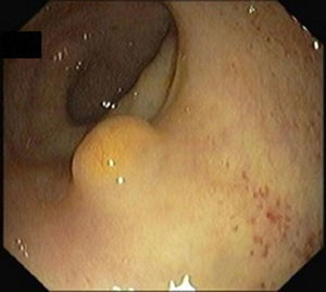 Submucosal tumor with yellow discolored mucosa.