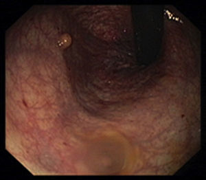 Colonoscopic view, in retroflexed maneuver, showing in the lower rectum a polypoid, yellowish, well-circumscribed lesion, measuring 5mm compatible with a rectal NET.