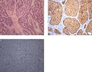Neuroendocrine tumor. Higher magnification showing monomorphic cells containing small, round nuclei and eosinophilic cytoplasm (a: H&E 200×). In the immunohistochemical study the tumor cells stained for synaptophysin (b: 200×) without expression of chromogranin A (c: 200×).