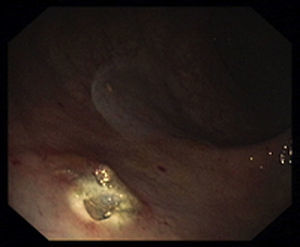 Colonoscopic view of the distal rectum after polypectomy of the rectal NET.