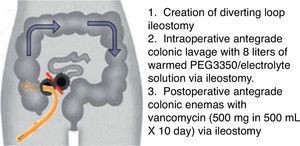 Diverting loop ileostomy and colonic lavage: operative strategy. Reproduced with permission from: Neal MD, Alverdy JC, Hall DE, et al. Diverting loop ileostomy and colonic lavage: an alternative to total abdominal colectomy for the treatment of severe, complicated Clostridium difficile associated disease. Ann Surg 2011; 254(3):423–7. Copyright© 2011 Lippincott Williams & Wilkins.