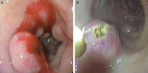 (A and B) Esophagogastroduodenoscopy revealed a subepithelial lesion with central ulceration and active bleeding in the antero-inferior wall of duodenal bulb (A) and endoscopic hemostasis was performed (B).