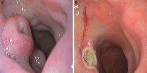 (A and B) Esophagogastroduodenoscopy showed the subepithelial lesion (A) and endoscopic view after endoscopic resection (B).