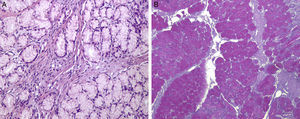 Histologic features of Brunner's gland proliferating lesion (A – H&E stain ×400 and B – Periodic acid-Schiff ×100).
