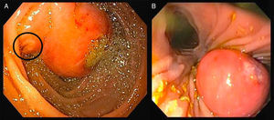 (A) Upper endoscopy; (B) duodenoscopy: 25mm large subepithelial lesion, distal to the duodenal papilla (black circle in A), with ulcerated top.