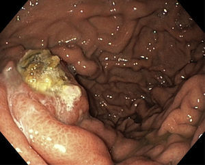 Upper gastrointestinal endoscopy, showing fundal varices after treatment with cyanoacrylate.