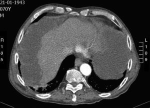 Abdominal CT axial view: low-attenuation heterogeneous ascites scalloping the margins of the liver and spleen.