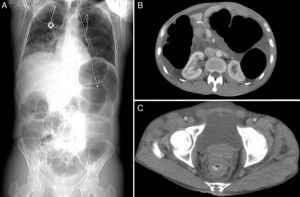 CT images revealing a large distension of the colon (A and B) proximally to a rectal stenosis with thickened wall and a radiopaque image in its lumen (C).