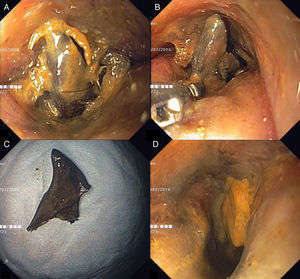 Endoscopic images showing a congestive rectal mucosa and a narrowed lumen with an impacted chicken bone occluding the luminal passage (A), which was removed with a rat-tooth forceps (B). After extraction of the foreign body (C), the malignant stricture was easily traversed and was only causing a minor narrowing of the lumen (D).