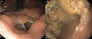 The orifice in the gastric body (A) allowing the passage of the endoscope to a cavity filled with necrotic debris (B).