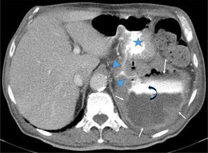 Axial CT after iodine injection and oral contrast. The image depicts a large exophitic tumor (arrows) arising from the posterior wall of the stomach (star). The tumor has central necrosis shown by a contrast-fluid level (curved-arrow). Oral contrast flowing from the stomach into the tumor cavity (arrowheads) is also noteworthy.