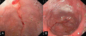 Widened gastric lumen (A) followed by a rotated segment located at mid-body of the stomach (B).