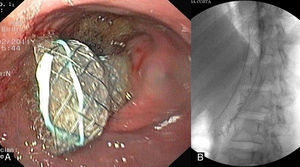Endoscopic (A) and fluoroscopic (B) view of fully covered self-expandable metallic stent in situ.