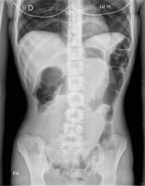 Abdominal radiograph. Marked gastric distension with gastric camera barely visible.