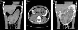 Abdominal tomography scan. Bulky bezoar difficult to characterize, occupying almost the entire gastric lumen and conditioning compression of neighboring structures.