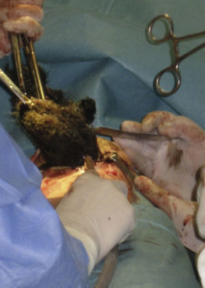 Gastrotomy and extraction of the trichobezoar 15-cm-long.