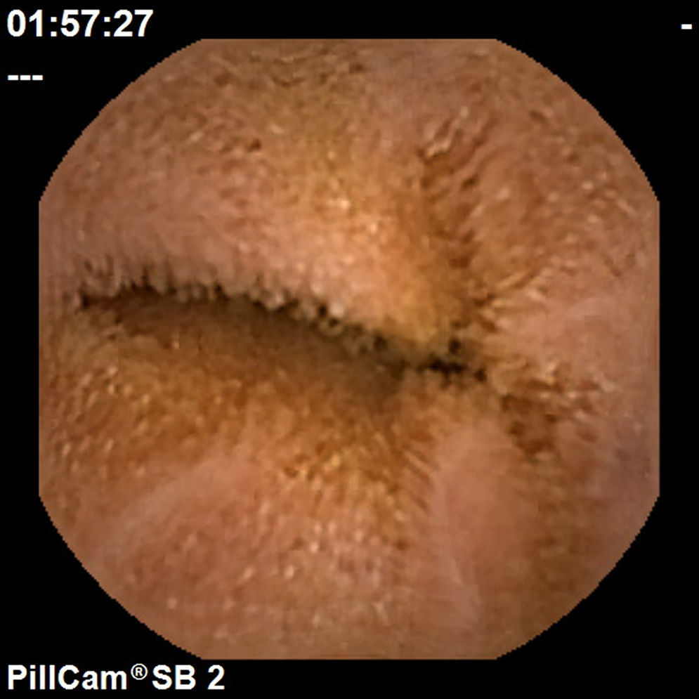 Small Intestine Endoscopy