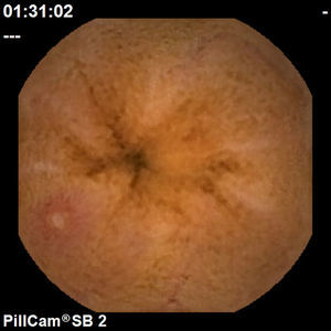 Aphthous ulcer.
