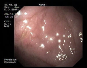 Upper gastrointestinal endoscopy, showing classic endoscopic signs of villous atrophy such as loss of Kerckring's folds in the duodenum, fissuring with a mosaic pattern, and also a small ulcer.