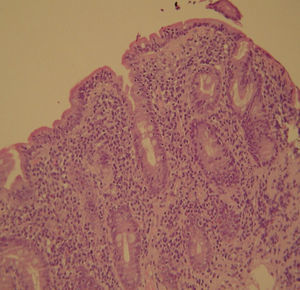Biopsies from the distal duodenum (H&E) showing severe villous atrophy together with intraepithelial lymphocytosis (>40 IELs/100 enterocytes) and crypt hyperplasia – Marsh-Oberhuber type 3b.
