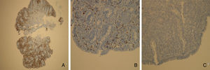 Immunohistochemistry images from the duodenal biopsies showing an abnormal population of IELs which are (A) CD3 positive, but (B) mostly CD8 negative and (C) CD30 negative.