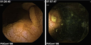 Videocapsule enteroscopy images showing grossly oedematous jejunum with flat mucosa, scalloping effect and a small ulcer.