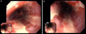 (a and b) Endoscopic findings, revealing extensive longitudinal esophageal deep ulceration and whitish plaque in the medium and distal esophagus.
